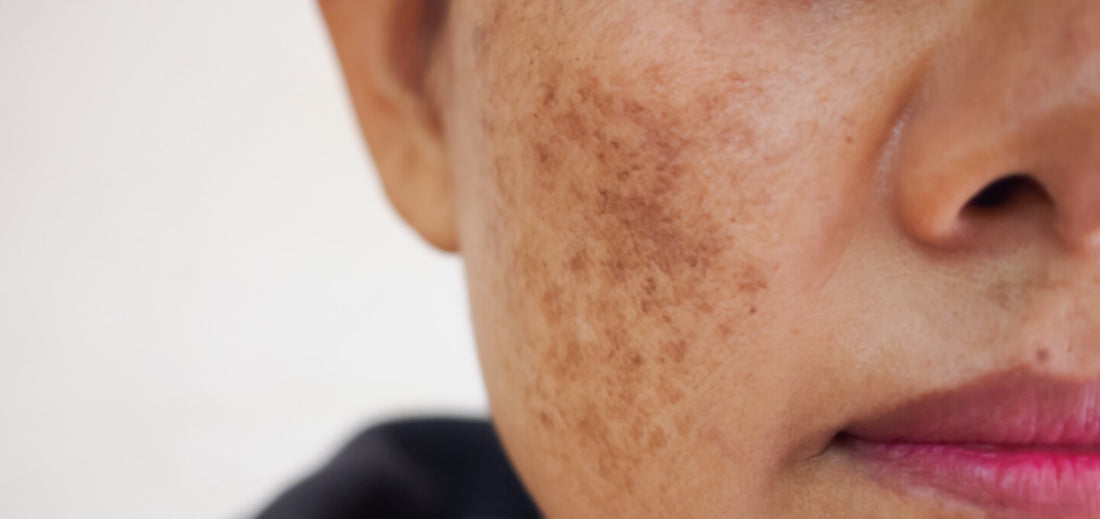 The Best Ways to Treat Melasma, According to Dermatologists